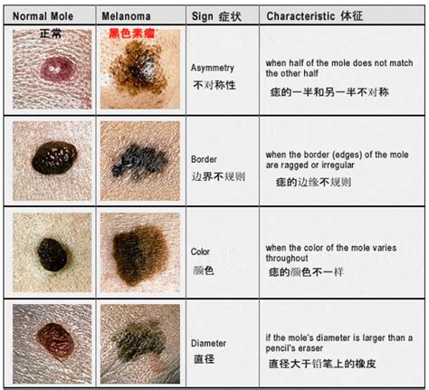 微凸的痣|痣也可能会癌变！长在 3 个地方要注意